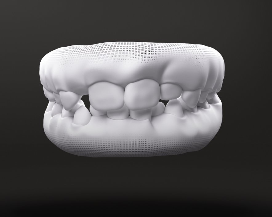 Invisalign First 3D Scan - kohe™ Dental