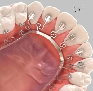 Lingual Braces (Brava by Brius) - kohe™ Dental