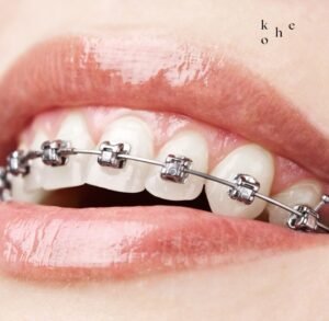 Self-Ligating Braces - kohe™ Dental