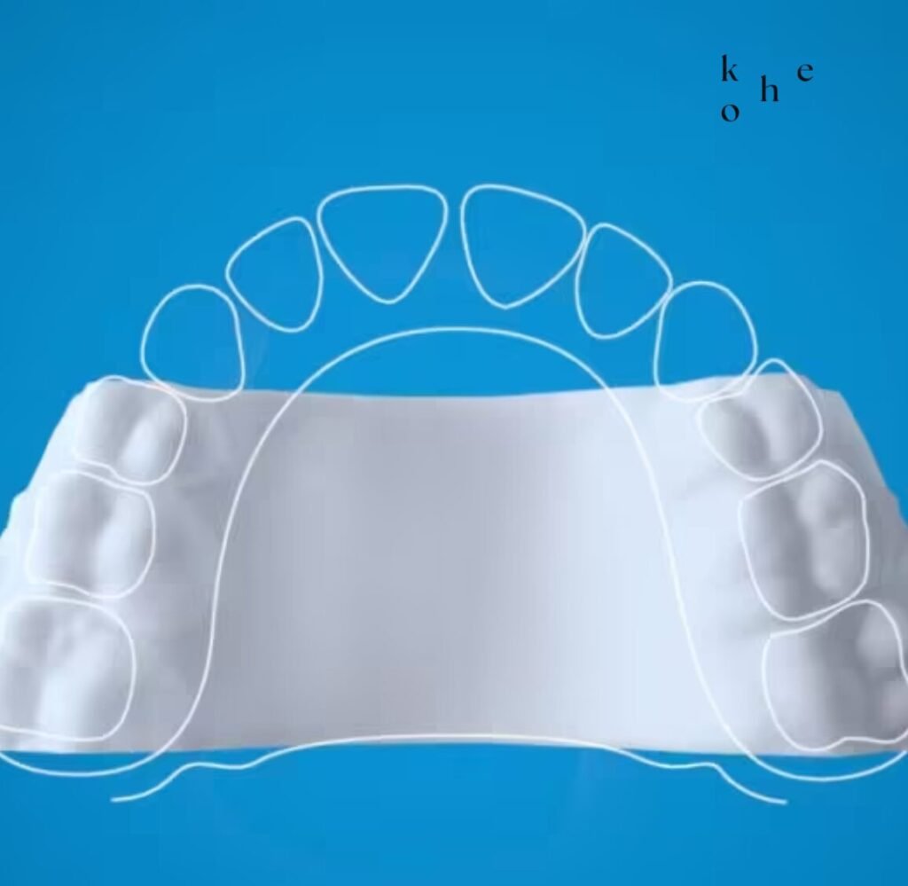 Invisalign Palatal Expander - kohe™ Dental